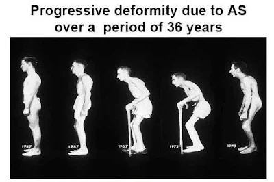 Ankylosing-spondylitis