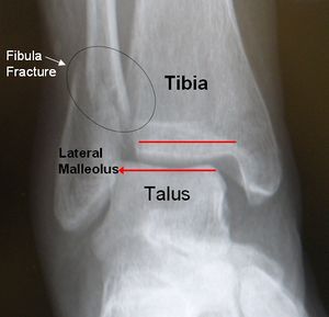 fibular-bone-fracture-surgery-fractured-fibular-types
