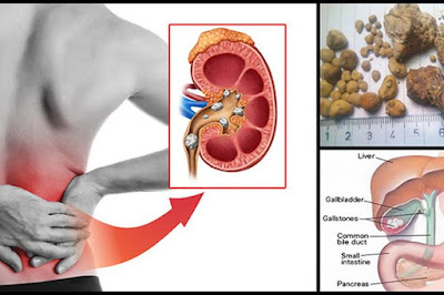 Rekomendasi Obat Batu Ginjal/ Kencing Batu Yang Terkenal Manjur