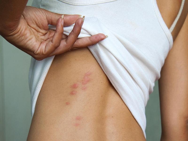 5 Causes of Hives You Wouldn't Expect
