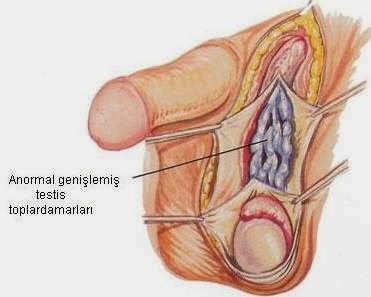  Testis Damar Genişlemesi