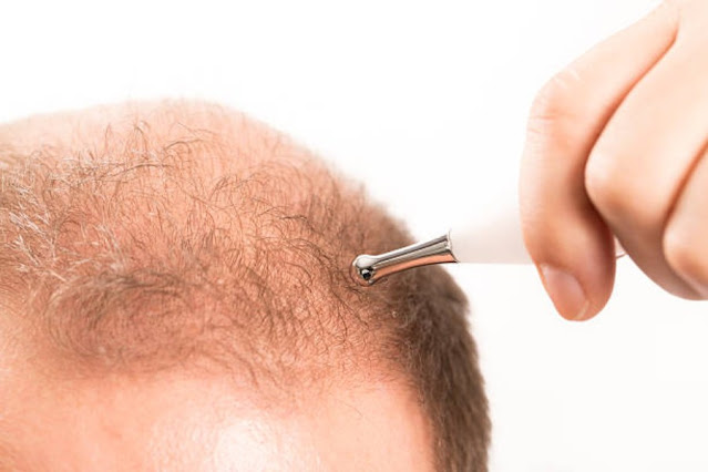 topical treatments for hair loss