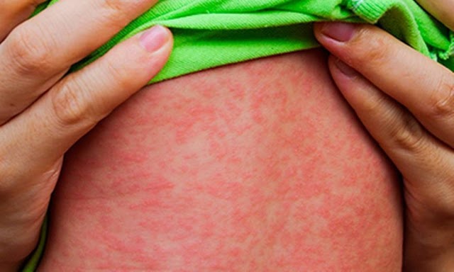 OMS alerta sobre forte aumento de casos de sarampo no mundo