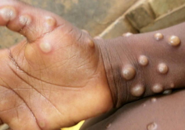 Sexto caso de varíola dos macacos é confirmado no país