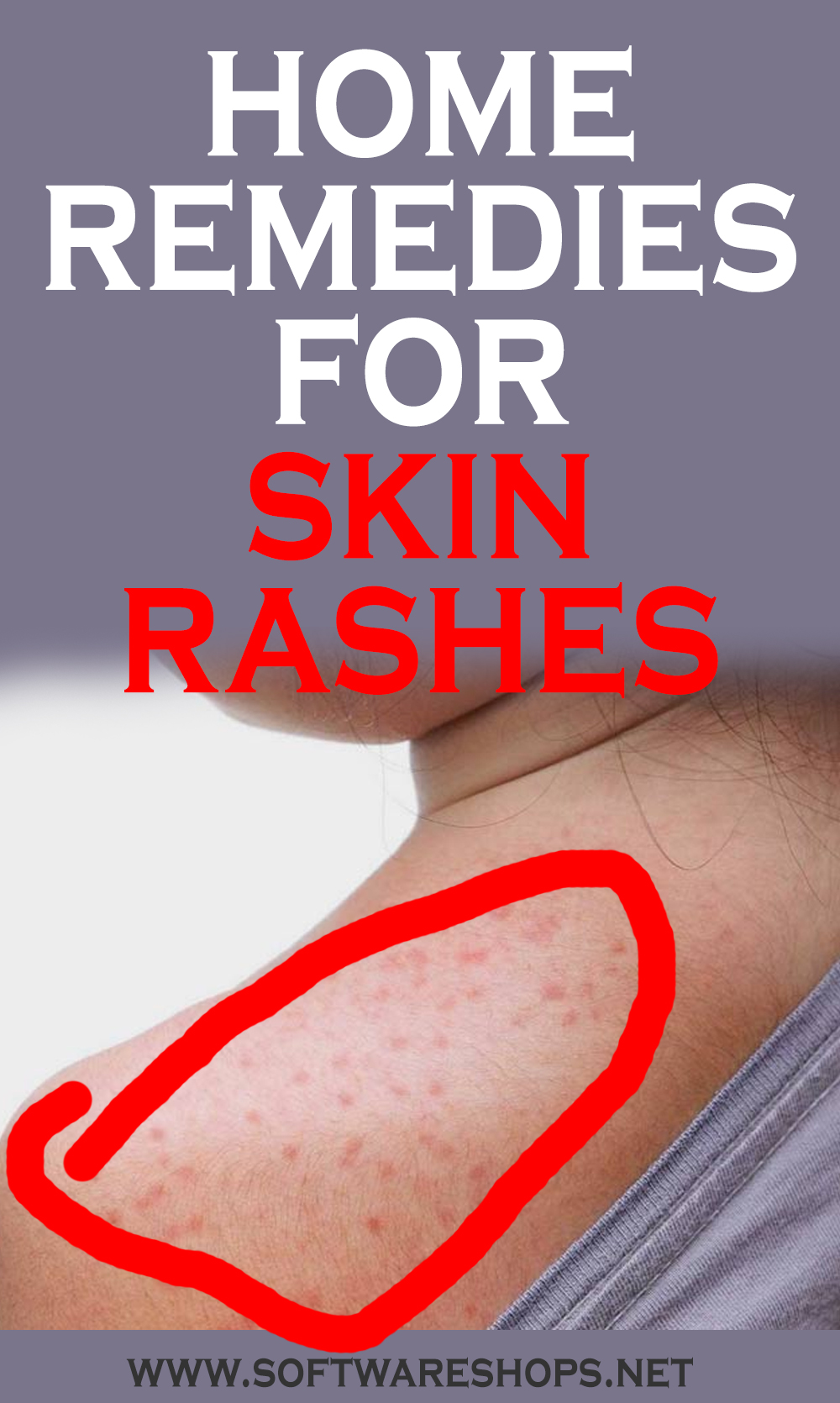 home remedies for skin rashes