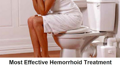 How To Treat Hemorrhoids Naturally?