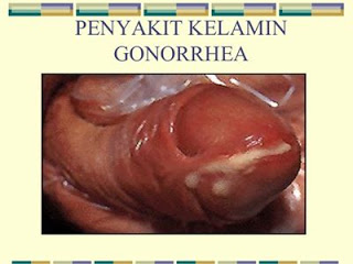 Obat gonore (kencing nanah) yang dijual di apotek, obat sipilis di batam, obat sipilis jakarta, daftar obat kencing nanah di apotik, apakah penyakit gonore berdampak ke hiv, air kencing campur nanah, kemaluan bengkak bernanah, efek samping dari penyakit kencing nanah, penyakit sipilis apa bisa sembuh, resep obat untuk kencing nanah, pengobatan penyakit sipilis pada wanita