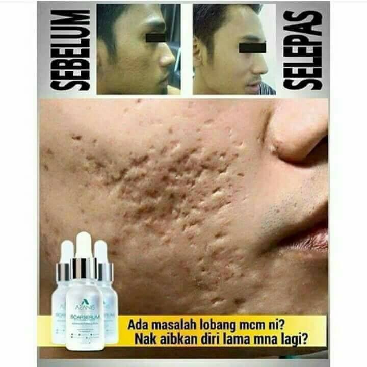 AZANIS V4 SCAR SERUM  SERUM PARUT LATEST PACKAGING  KAK 