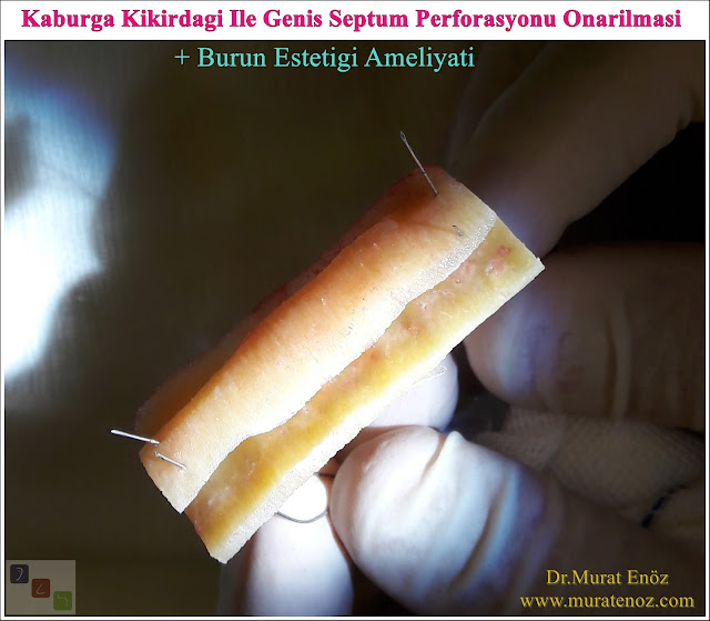 Nazal septum perforasyonu - Septum perforasyonu ameliyatı olanlar - Septum perforasyonu olanlar - Septum perforasyonu ameliyatı yapan doktorlar - Burunda delik oluşumu - Burun duvarında delik - Burun kıkırdak delinmesi tedavisi - Septum perforasyonu ameliyatı olanlar - Septum perforasyonu olanlar - Septal perforasyon tamiri - Septal buton uygulaması - Nazal septum perforasyonu tedavisi - Nazal septum perforasyonu nedenleri - Nazal septum perforasyonu belirtileri - Septum perforasyonun cerrahi onarımı - Burun delinmesinin nedenleri - Nazal septum perforasyonu tanısı - Erkek burun estetiği - Burun estetiği ameliyatı - Definition of Nasal Septal Perforation - Causes of Perforated Nasal Septum - Symptoms of Nasal Septal Perforation - Diagnosis of Nasal Septal Perforation - Surgical Treatment For Nasal Septal Perforation - Nasal Septal Perforation Repair - Surgical Repair of Nasal Septal Perforation