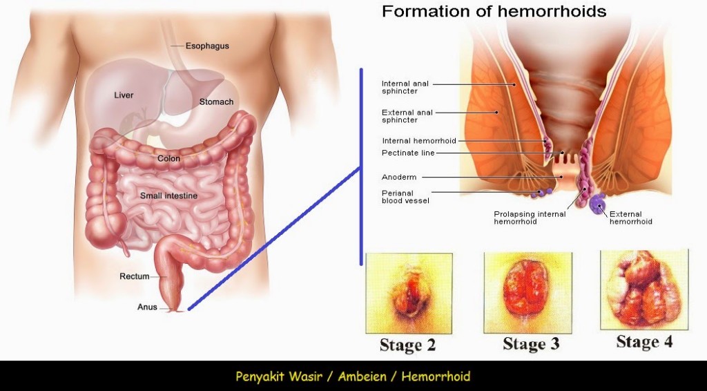 Obat Ampuh Untuk Mengobati Wasir