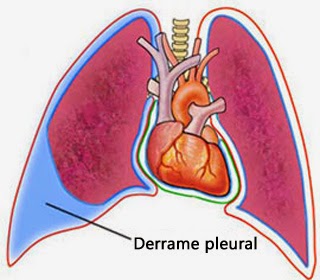 Pleuresía: síntomas, causas y tratamientos