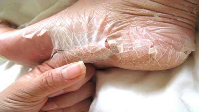 peeling skin: The possible causes and home remedies    