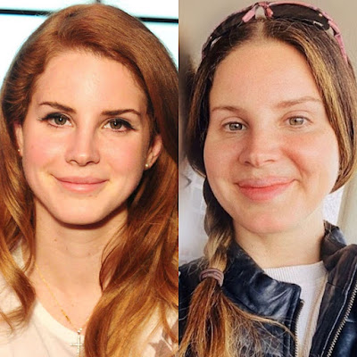Lana Del Rey Before And After Plastic Surgery