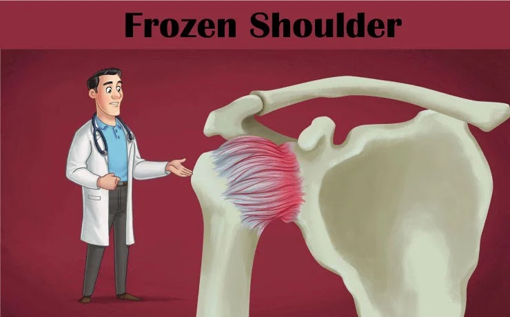 Frozen shoulder: what it is, its stages, signs and symptoms, and physical therapy treatment