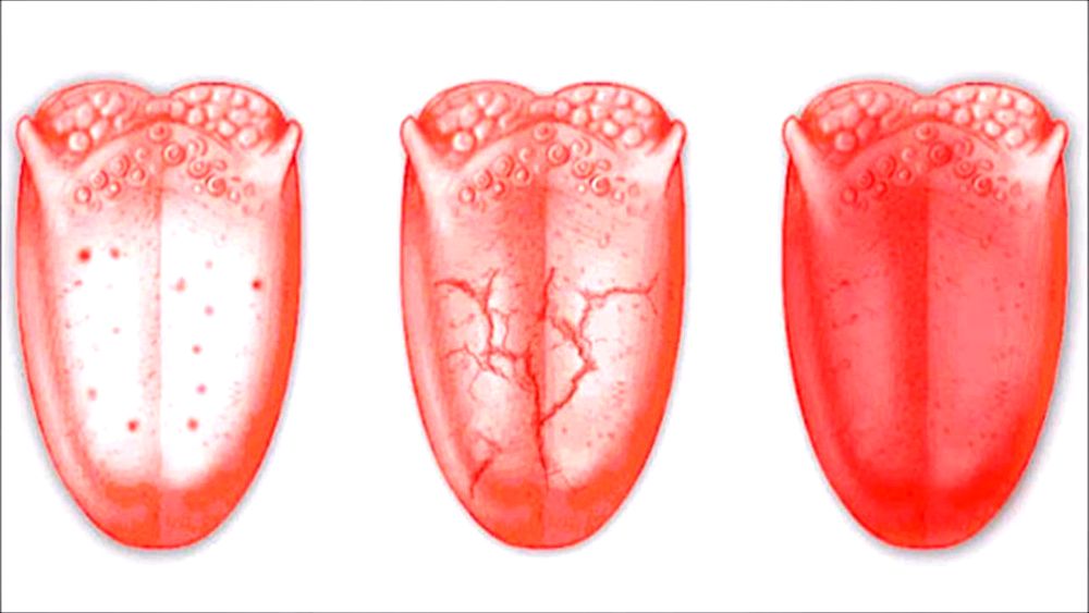 Lesions Tongue