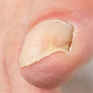 10 Surprising Symptoms of Nail Fungus You Need to Know