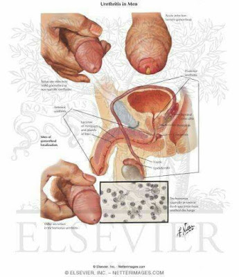 Non Gononococcal Urethritis (NGU): Causes, Symptoms, Effects And Treatment