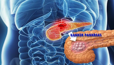 Cegah Kanker Pankreas Dengan Vitamin A