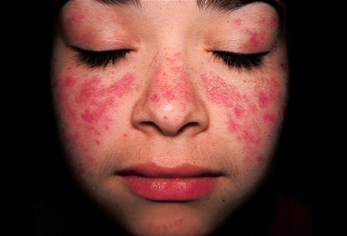 In brief about Lupus