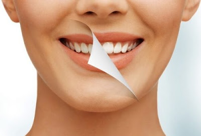 Tẩy trắng răng bằng laser whitening bao nhiêu tiền?