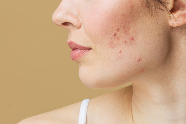 Acne scars treatment Penrith