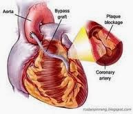 http://pengobatansinusitis01.blogspot.com/2013/11/pengobatan-jantung-bocor-tanpa-operasi.html