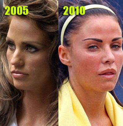 Katie Price before plastic surgery