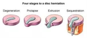 Disk Herniasyon Aşamaları