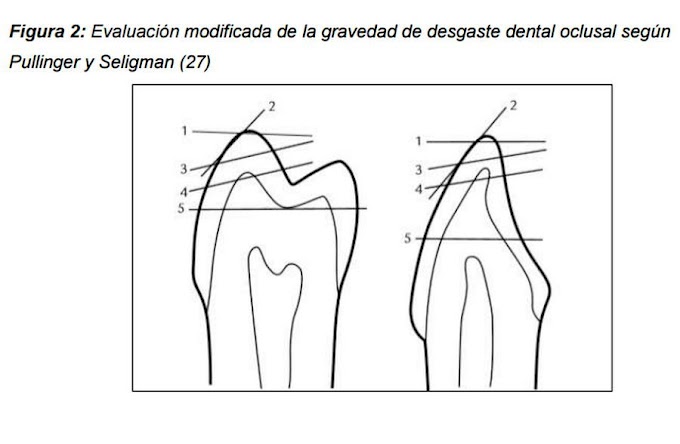 PDF: El Desgaste Severo en Odontología 