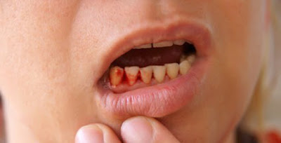 Chảy máu chân răng khi mang thai có nguy hiểm không?-1