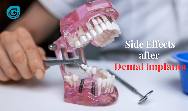 Side Effects after Dental Implant