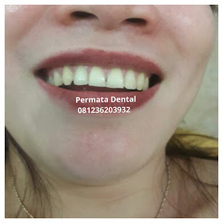 gambar foto contoh sebelum dan sesudah veneer gigi kelinci buatan manis cantik bali jember banyuwangi murah berkualitas di PERMATA DENTAL gambar gigi rusak yang di veneer gigi yang tidak rapi gigi renggang gigi patah cuil rompal pendek karies hitam kuning