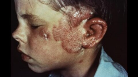 Israel medicine human experiments ringworm radiation children harms deception misconduct technocracy genocide irradiation x-rays