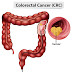  Colon Cancer – The chance is actual