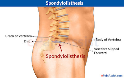 spondylolisthesis