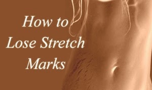 Cara Cepat Menghilangkan Stretch Mark