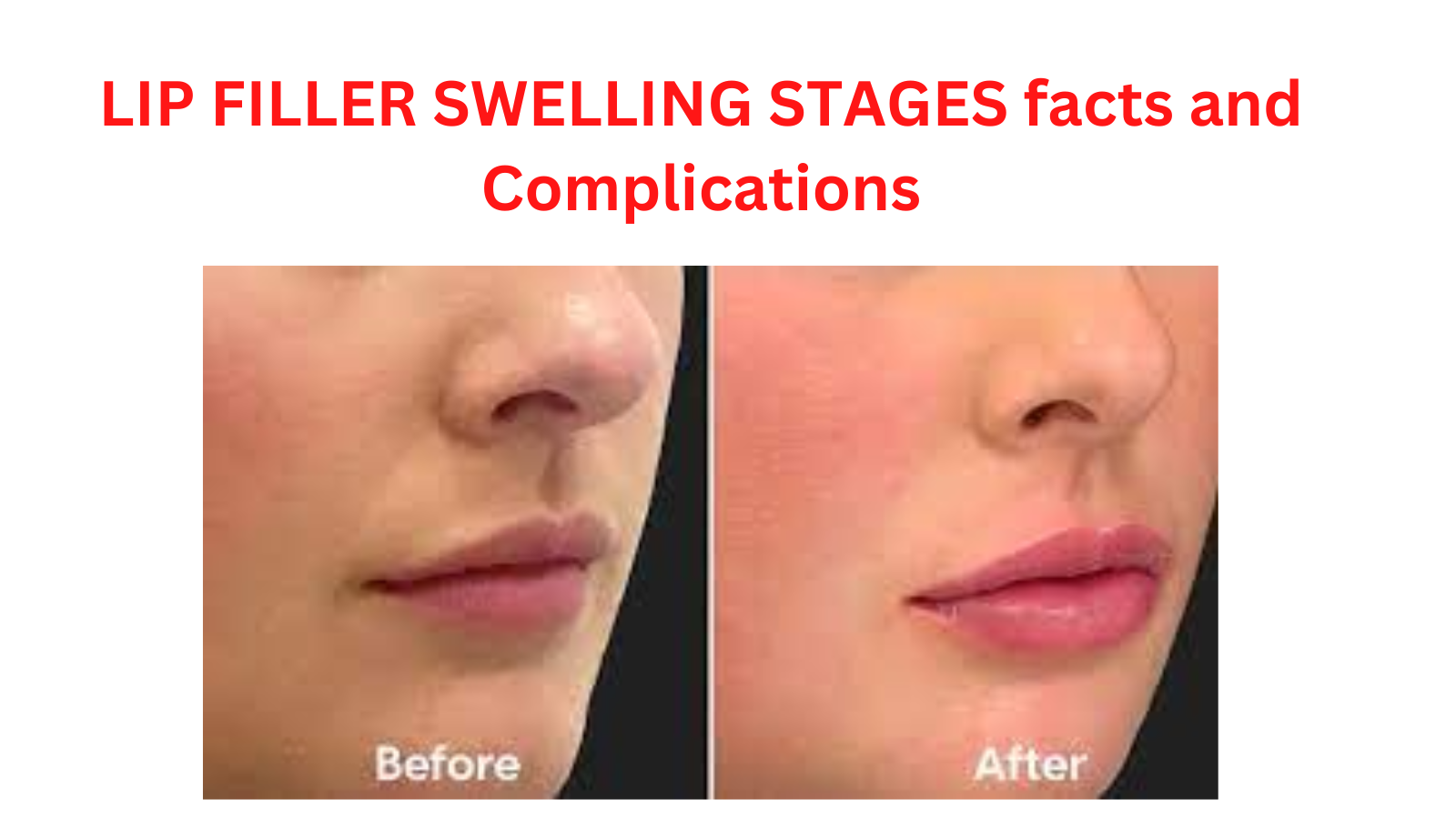 LIP FILLER SWELLING STAGES facts and Complications