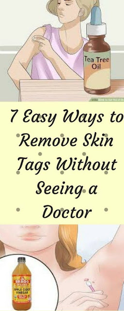 7 EASY WAYS TO REMOVE SKIN TAGS WITHOUT SEEING A DOCTOR