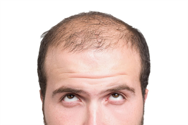 How to Manage Hair Loss With Your Modern Lifestyle