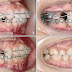 Có thể thực hiện niềng răng không nhổ răng khểnh được không?