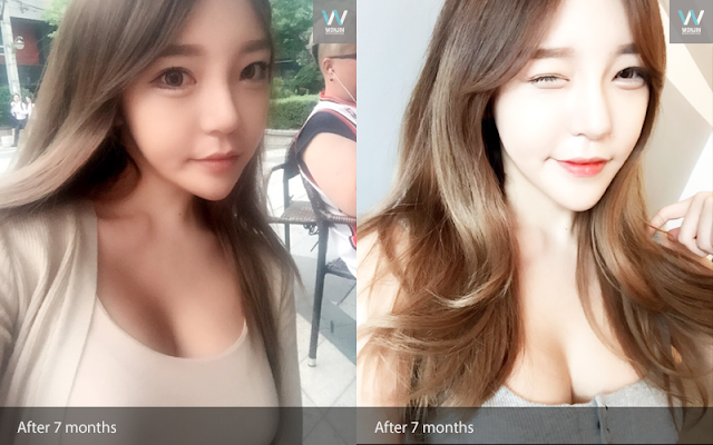 짱이뻐! - Gangnam Breast Plastic Surgery Review: Now I Love My Face Shape