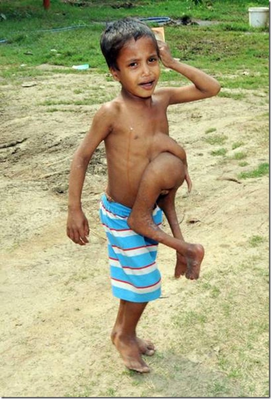 India´s octo-limbo kid wants help