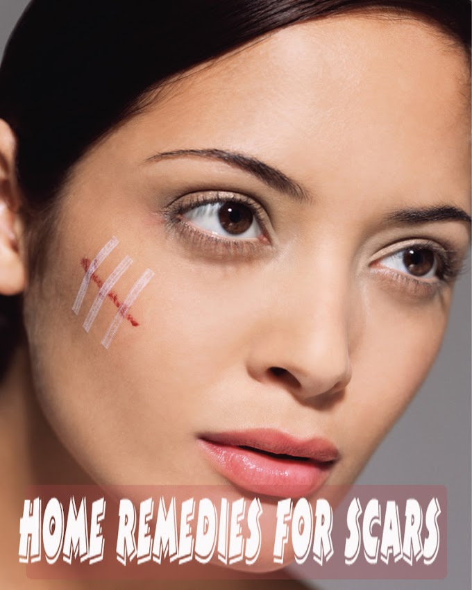 Home Remedies for Scars