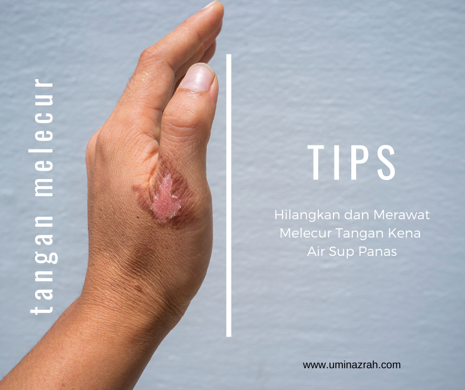 Tips Hilangkan dan Merawat Melecur Tangan Kena Air Sup 