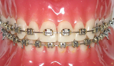 Tìm hiểu ưu điểm của niềng răng mắc cài inox