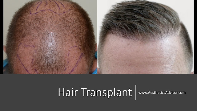 hair transplant basics