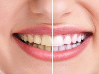 Tips Dan Cara Mengatasi Gigi Kuning Secara Alami (Bagi Perokok)