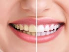 Tips Dan Cara Mengatasi Gigi Kuning Secara Alami (Bagi Perokok)