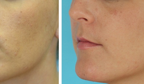 Laser Treatment For Acne Scars