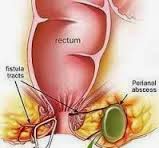 Cara Pengobatan Fistula Ani Tanpa Operasi